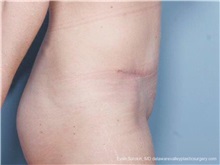 Tummy Tuck After Photo by Evan Sorokin, MD; ,  - Case 36368