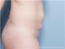 Tummy Tuck Before Photo by Evan Sorokin, MD; ,  - Case 36368