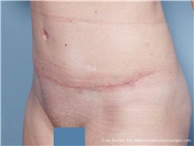 Tummy Tuck After Photo by Evan Sorokin, MD; ,  - Case 36368