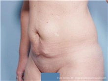 Tummy Tuck Before Photo by Evan Sorokin, MD; ,  - Case 36368