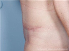 Tummy Tuck After Photo by Evan Sorokin, MD; ,  - Case 36368