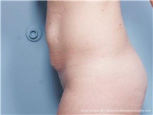 Tummy Tuck Before Photo by Evan Sorokin, MD; ,  - Case 36368