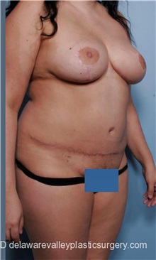 Mommy Makeover After Photo by Evan Sorokin, MD; Cherry Hill, NJ - Case 36434