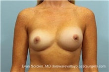 Breast Implant Revision Before Photo by Evan Sorokin, MD; Cherry Hill, NJ - Case 36441