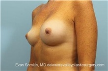 Breast Implant Revision Before Photo by Evan Sorokin, MD; Cherry Hill, NJ - Case 36441