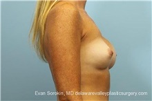 Breast Implant Revision Before Photo by Evan Sorokin, MD; Cherry Hill, NJ - Case 36441