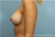 Breast Implant Revision After Photo by Evan Sorokin, MD; Cherry Hill, NJ - Case 36441