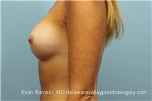 Breast Implant Revision Before Photo by Evan Sorokin, MD; Cherry Hill, NJ - Case 36441