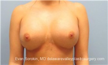 Breast Implant Revision After Photo by Evan Sorokin, MD; Cherry Hill, NJ - Case 36442
