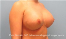 Breast Implant Revision After Photo by Evan Sorokin, MD; Cherry Hill, NJ - Case 36442