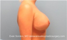 Breast Implant Revision After Photo by Evan Sorokin, MD; Cherry Hill, NJ - Case 36442