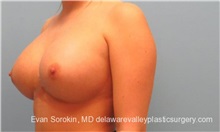 Breast Implant Revision After Photo by Evan Sorokin, MD; Cherry Hill, NJ - Case 36442