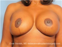Breast Lift After Photo by Evan Sorokin, MD; Cherry Hill, NJ - Case 36449