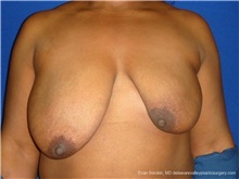 Breast Lift Before Photo by Evan Sorokin, MD; Cherry Hill, NJ - Case 36449