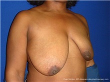 Breast Lift Before Photo by Evan Sorokin, MD; Cherry Hill, NJ - Case 36449