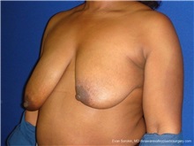 Breast Lift Before Photo by Evan Sorokin, MD; Cherry Hill, NJ - Case 36449