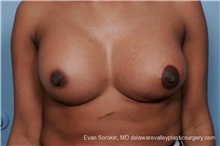 Breast Lift After Photo by Evan Sorokin, MD; Cherry Hill, NJ - Case 36452