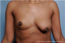 Breast Lift Before Photo by Evan Sorokin, MD; Cherry Hill, NJ - Case 36452