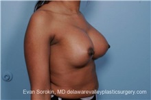 Breast Lift After Photo by Evan Sorokin, MD; Cherry Hill, NJ - Case 36452