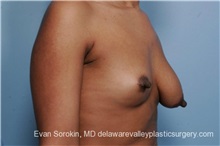 Breast Lift Before Photo by Evan Sorokin, MD; Cherry Hill, NJ - Case 36452