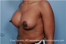 Breast Lift After Photo by Evan Sorokin, MD; Cherry Hill, NJ - Case 36452