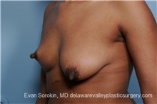 Breast Lift Before Photo by Evan Sorokin, MD; Cherry Hill, NJ - Case 36452