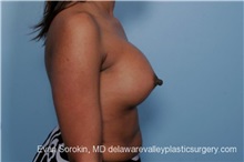Breast Lift After Photo by Evan Sorokin, MD; Cherry Hill, NJ - Case 36452