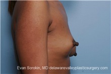 Breast Lift Before Photo by Evan Sorokin, MD; Cherry Hill, NJ - Case 36452