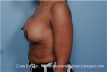 Breast Lift After Photo by Evan Sorokin, MD; Cherry Hill, NJ - Case 36452