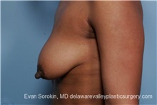 Breast Lift Before Photo by Evan Sorokin, MD; Cherry Hill, NJ - Case 36452