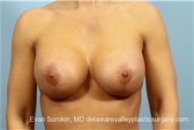 Breast Lift After Photo by Evan Sorokin, MD; Cherry Hill, NJ - Case 36453