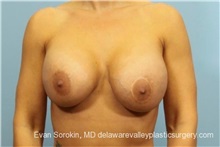 Breast Lift Before Photo by Evan Sorokin, MD; Cherry Hill, NJ - Case 36453
