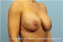 Breast Lift Before Photo by Evan Sorokin, MD; Cherry Hill, NJ - Case 36453