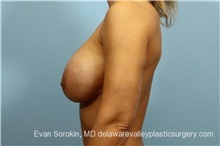Breast Lift Before Photo by Evan Sorokin, MD; Cherry Hill, NJ - Case 36453