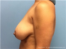 Breast Lift Before Photo by Evan Sorokin, MD; Cherry Hill, NJ - Case 36460