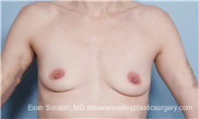 Breast Augmentation Before Photo by Evan Sorokin, MD; Cherry Hill, NJ - Case 36463