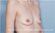 Breast Augmentation Before Photo by Evan Sorokin, MD; Cherry Hill, NJ - Case 36463
