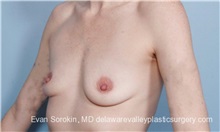 Breast Augmentation Before Photo by Evan Sorokin, MD; Cherry Hill, NJ - Case 36463