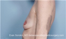 Breast Augmentation Before Photo by Evan Sorokin, MD; Cherry Hill, NJ - Case 36463