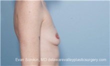 Breast Augmentation Before Photo by Evan Sorokin, MD; Cherry Hill, NJ - Case 36463