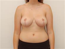 Breast Reduction After Photo by John Anastasatos, MD; Los Angeles, CA - Case 29300