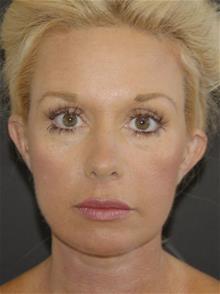 Facelift After Photo by John Anastasatos, MD; Los Angeles, CA - Case 29302