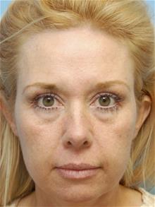 Facelift Before Photo by John Anastasatos, MD; Los Angeles, CA - Case 29302