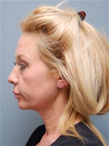 Facelift Before Photo by John Anastasatos, MD; Los Angeles, CA - Case 29302