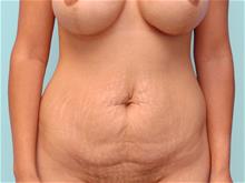 Tummy Tuck Before Photo by John Anastasatos, MD; Los Angeles, CA - Case 29303