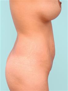 Tummy Tuck Before Photo by John Anastasatos, MD; Los Angeles, CA - Case 29303