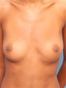 Breast Augmentation Before Photo by John Anastasatos, MD; Los Angeles, CA - Case 29304