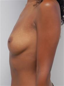 Breast Augmentation Before Photo by John Anastasatos, MD; Los Angeles, CA - Case 29304
