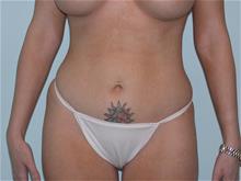 LSNA Suction Liposuction After Photo by John Anastasatos, MD; Los Angeles, CA - Case 29305