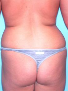 LSNA Suction Liposuction Before Photo by John Anastasatos, MD; Los Angeles, CA - Case 29305
